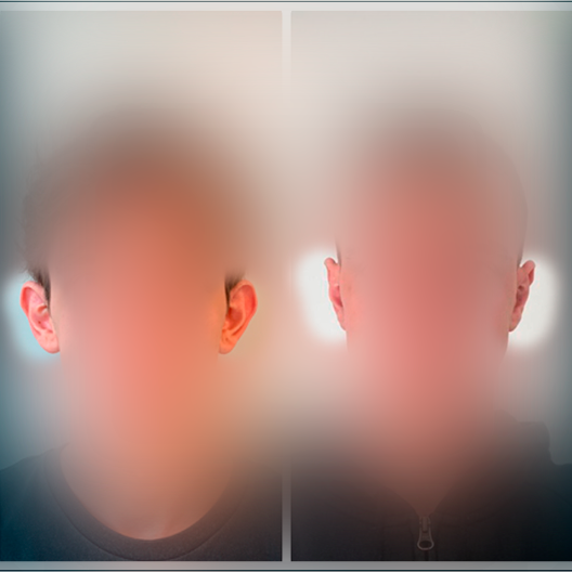 DR-ANTONIO-TEIXEIRA-ANTES-DEPOIS-02
