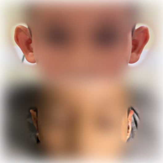 DR-ANTONIO-TEIXEIRA-ANTES-DEPOIS-07
